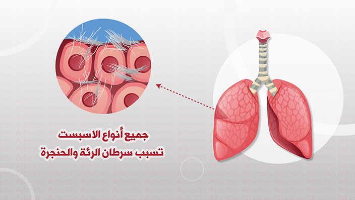 ترامس روز | الأسبستوس يسبب سرطان الرئة